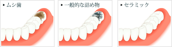 ムシ歯 一般的な詰め物 セラミック