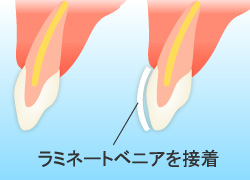 ラミネートベニアを接着